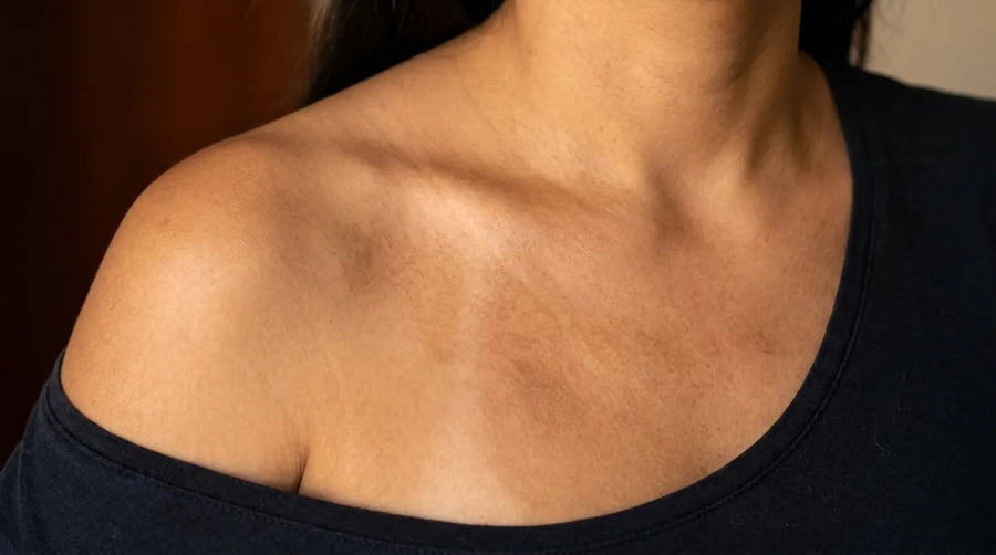 Piel con manchas y sin protección solar